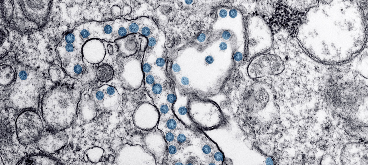 Imagem microscópica digitalmente aprimorada mostra uma infecção por coronavírus em azul